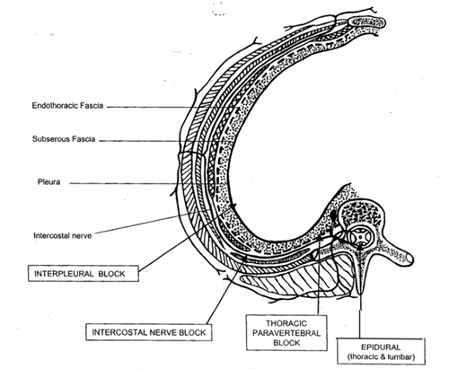 Figure 1. The anatomic location of delivery for the various modalities of regional thoracic analgesia From Karmakar MJ, Anthony MH, Acute Pain Management of Patients with Multiple Rib Fractures.